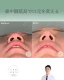 鼻中隔延長で口元をきれいにする after画像 サムネイル用