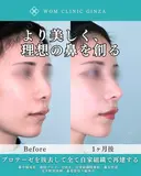より美しく、理想の鼻を創る before画像 サムネイル用