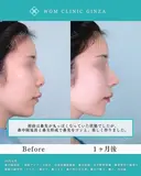 より美しく、理想の鼻を創る 30日後 サムネイル用