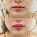 スマイルリップ(唇ヒアル+口角ボト) before画像 サムネイル用