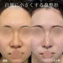 鼻尖形成、軟骨移植、鼻柱下降、鼻翼縮小、プロテーゼ、鼻孔縁挙上 after画像 サムネイル用