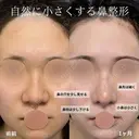 鼻尖形成、軟骨移植、鼻柱下降、鼻翼縮小、プロテーゼ、鼻孔縁挙上 before画像 サムネイル用