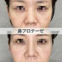鼻プロテーゼで理想の高さに😍🌷✨隆鼻術 before画像 サムネイル用