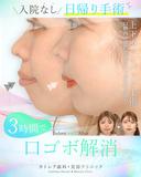 出っ歯🦷口元の膨らみ💋上下セットバック 90日後 サムネイル用