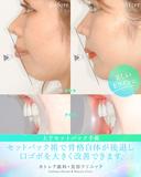 出っ歯🦷口元の膨らみ💋上下セットバック 90日後 サムネイル用