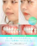 出っ歯🦷口元の膨らみ💋上下セットバック 90日後 サムネイル用