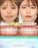 出っ歯🦷口元の膨らみ💋上下セットバック 90日後 サムネイル用