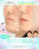 受け口・反対のかみ合わせ🦷下顎セットバック 180日後 サムネイル用