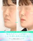 受け口・反対のかみ合わせ🦷下顎セットバック 180日後 サムネイル用