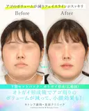 受け口・反対のかみ合わせ🦷下顎セットバック 180日後 サムネイル用