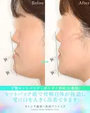 受け口・反対のかみ合わせ🦷下顎セットバック before画像 サムネイル用