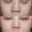 【20代女性・鼻先スッキリ】鼻尖縮小術＋α法（2週間後） before画像 サムネイル用