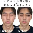 ヒアルロン酸(あご)＋ボトックス(エラ) before画像 サムネイル用