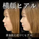 顎ヒアルロン酸×鼻先ヒアルロン酸 after画像 サムネイル用