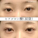 涙袋ヒアルロン酸 注入術 before画像 サムネイル用