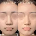 鼻尖形成、軟骨移植、鼻柱下降、鼻翼縮小 after画像 サムネイル用
