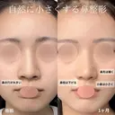 鼻尖形成、軟骨移植、鼻柱下降、鼻翼縮小 before画像 サムネイル用