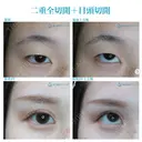 【20代女性（施術当時は10代）・アイプチ卒業】二重全切開＋目頭切開手術（2年後） before画像 サムネイル用