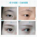 【20代女性（施術当時は10代）・アイプチ卒業】二重全切開＋目頭切開手術（2年後） after画像 サムネイル用