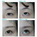 【20代女性（施術当時は10代）・アイプチ卒業】二重全切開＋目頭切開手術（2年後） after画像 サムネイル用