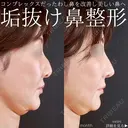 鼻整形 30日後 サムネイル用
