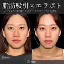 🌻【脂肪吸引】【エラボトックス】で理想の小顔に🌻 before画像 サムネイル用