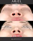 小鼻縮小内側・鼻孔縁挙上 before画像 サムネイル用