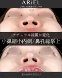 小鼻縮小内側・鼻孔縁挙上 30日後 サムネイル用