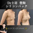 シリコンバック豊胸 before画像 サムネイル用