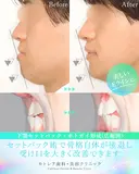 受け口、反対のかみ合わせ🦷下顎セットバック 90日後 サムネイル用
