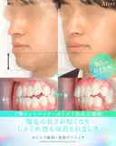 受け口、反対のかみ合わせ🦷下顎セットバック 90日後 サムネイル用