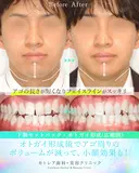 受け口、反対のかみ合わせ🦷下顎セットバック 90日後 サムネイル用