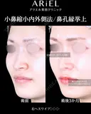 小鼻縮小内側・鼻孔縁挙上 before画像 サムネイル用