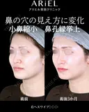 小鼻縮小内側・鼻孔縁挙上 90日後 サムネイル用