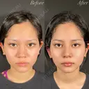 鼻整形－複合－ before画像 サムネイル用