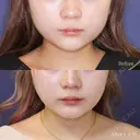エラ張りさん必見！！ 👀✨ 30日後 サムネイル用
