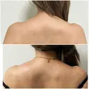 肩（僧帽筋）ボトックス before画像 サムネイル用
