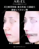 軟骨移植 /軟骨トリム/鼻尖形成 /小鼻縮小 /フラップ固定/鼻根ヒアルロン酸 before画像 サムネイル用