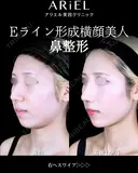 軟骨移植 /軟骨トリム/鼻尖形成 /小鼻縮小 /フラップ固定/鼻根ヒアルロン酸 30日後 サムネイル用