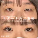 エターナル二重術+まぶたの上の脂肪取り before画像 サムネイル用