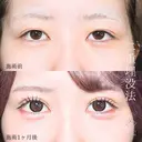 選べるオーダメイド二重埋没法 after画像 サムネイル用