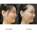 【院長施術】ボトックス注射【目尻、口角、人中】 before画像 サムネイル用