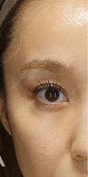 【目を美しくする治療👀✨】 after画像 サムネイル用