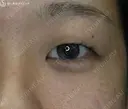【20代女性・腫れは最低限】腫れにくい二重術　マイクロメソッド＋α before画像 サムネイル用