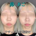 鼻ヒアルロン酸　顎ヒアルロン酸 after画像 サムネイル用