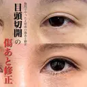 目頭切開の傷跡修正 after画像 サムネイル用
