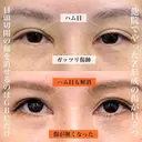 目頭切開の傷跡修正 before画像 サムネイル用