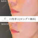 口角挙上(ロング＋細糸) before画像 サムネイル用