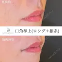 口角挙上(ロング＋細糸) after画像 サムネイル用
