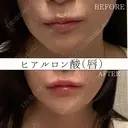 唇ヒアルロン酸 注入術 after画像 サムネイル用